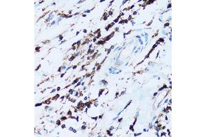Immunohistochemistry of paraffin-embedded human breast cancer using SPN antibody (ABIN5973813) at dilution of 1/100 (40x lens). (CD43 anticorps)
