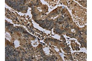 The image on the left is immunohistochemistry of paraffin-embedded Human colon cancer tissue using ABIN7129664(GSTO1 Antibody) at dilution 1/60, on the right is treated with fusion protein. (GSTO1 anticorps)