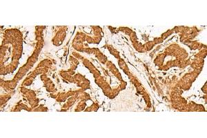 Immunohistochemistry of paraffin-embedded Human thyroid cancer tissue using GMEB2 Polyclonal Antibody at dilution of 1:35(x200)