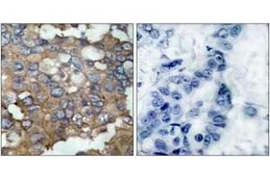 Immunohistochemistry analysis of paraffin-embedded human breast carcinoma tissue, using Src (Ab-529) Antibody.