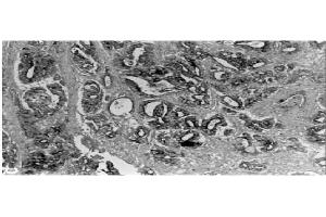 Immunohistochemical staining  of human gastric carcinoma tissue using MMP-3 antibody . (MMP3 anticorps  (C-Term))