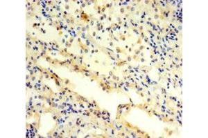 Immunohistochemistry of paraffin-embedded human lung cancer using ABIN7142230 at dilution of 1:100