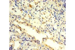Immunohistochemistry of paraffin-embedded human lung cancer using ABIN7142230 at dilution of 1:100 (PSMC3 anticorps  (Regulatory Subunit 6A))