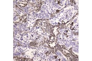 IHC testing of FFPE human lung cancer tissue with MVP antibody at 1ug/ml. (MVP anticorps)