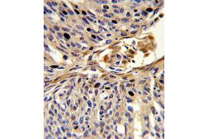 Formalin-fixed and paraffin-embedded human lung carcinoma reacted with APEX2 Antibody , which was peroxidase-conjugated to the secondary antibody, followed by DAB staining. (APEX2 anticorps  (AA 143-171))