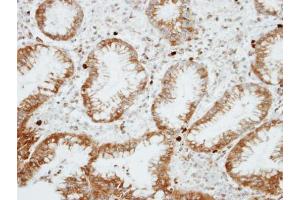 IHC-P Image Immunohistochemical analysis of paraffin-embedded human gastric cancer, using RGS14, antibody at 1:100 dilution. (RGS14 anticorps  (C-Term))