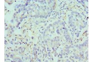 Immunohistochemistry of paraffin-embedded human lung cancer using ABIN7144586 at dilution of 1:100