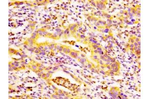 IHC image of ABIN7173899 diluted at 1:500 and staining in paraffin-embedded human bladder cancer performed on a Leica BondTM system.