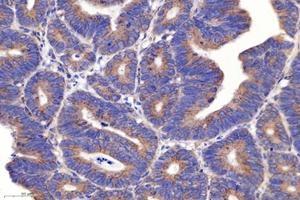 Immunohistochemistry analysis of paraffin-embedded human colon cancer using PSMD8 (ABIN7075226) at dilution of 1: 2600