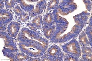 Immunohistochemistry analysis of paraffin-embedded human colon cancer using PSMD8 (ABIN7075226) at dilution of 1: 2600 (PSMD8 anticorps)