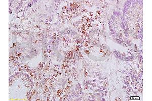 Formalin-fixed and paraffin embedded human rectal carcinoma labeled with Anti-Integrin beta 3/CD61 Polyclonal Antibody, Unconjugated (ABIN739029) at 1:200, followed by conjugation to the secondary antibody and DAB staining (Integrin beta 3 anticorps  (AA 27-120))