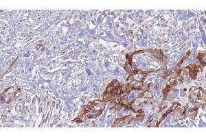 ABIN6274443 at 1/100 staining Human urothelial cancer tissue by IHC-P. (EPS8-Like 1 anticorps  (Internal Region))