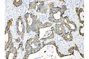 Cytokeratin 18 was detected in paraffin-embedded sections of human intetsinal cancer tissues using rabbit anti- Cytokeratin 18 Antigen Affinity purified polyclonal antibody (Catalog # ) at 1 µg/mL.