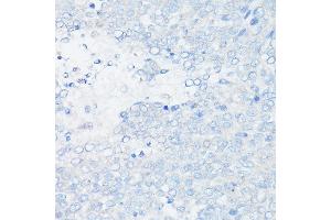 Immunohistochemistry of paraffin-embedded Human liver cancer (negative control sample) using MUC1 Rabbit mAb (ABIN7268687) at dilution of 1:100 (40x lens). (MUC1 anticorps)