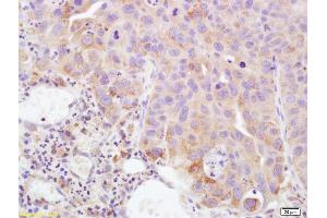 Formalin-fixed and paraffin embedded human bladder carcinoma labeled with Rabbit Anti PTGEs Polyclonal Antibody, Unconjugated (ABIN735788) at 1:200 followed by conjugation to the secondary antibody and DAB staining (Prostaglandin E Synthase anticorps  (AA 85-152))