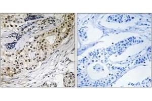 Immunohistochemistry analysis of paraffin-embedded human colon carcinoma tissue, using LAMA3 Antibody. (LAMA3 anticorps  (AA 2571-2620))