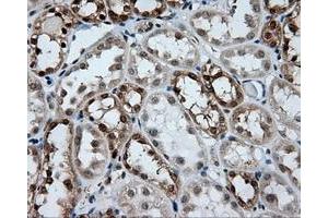 Immunohistochemical staining of paraffin-embedded Carcinoma of liver tissue using anti-GBE1 mouse monoclonal antibody. (GBE1 anticorps)