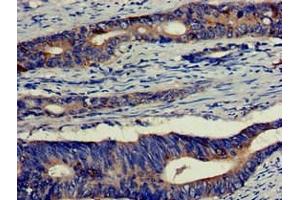Immunohistochemistry of paraffin-embedded human colon cancer using ABIN7152180 at dilution of 1:100
