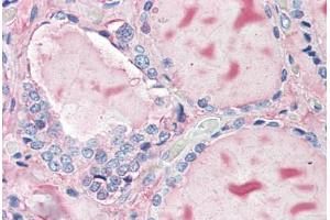 Human Thyroid (formalin-fixed, paraffin-embedded) stained with TG antibody ABIN396967 at 10 ug/ml followed by biotinylated anti-mouse IgG secondary antibody ABIN481714, alkaline phosphatase-streptavidin and chromogen.