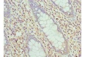 Immunohistochemistry of paraffin-embedded human colon cancer using ABIN7158340 at dilution of 1:100