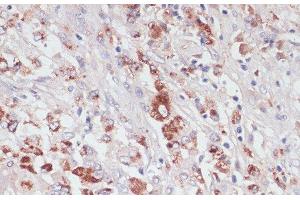 Immunohistochemistry of paraffin-embedded Human liver cancer using LYZ Polyclonal Antibody at dilution of 1:100 (40x lens). (LYZ anticorps)