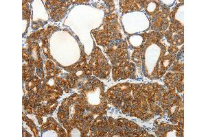 Immunohistochemistry of Human colon cancer using SLC12A4 Polyclonal Antibody at dilution of 1:30