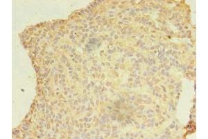Immunohistochemistry of paraffin-embedded human breast cancer using ABIN7174932 at dilution of 1:100 (CFAP92/KIAA1257 anticorps  (AA 1-297))