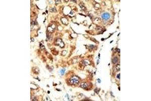 Formalin-fixed and paraffin-embedded human cancer tissue reacted with the primary antibody, which was peroxidase-conjugated to the secondary antibody, followed by AEC staining. (MAGI1 anticorps  (C-Term))