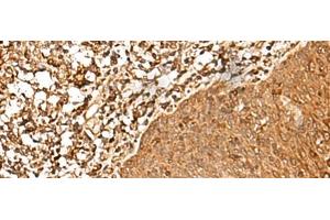 Immunohistochemistry of paraffin-embedded Human esophagus cancer tissue using FAM50A Polyclonal Antibody at dilution of 1:25(x200) (FAM50A anticorps)