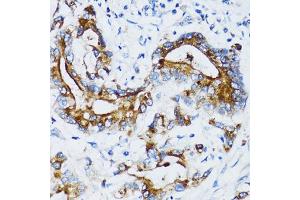 Immunohistochemistry of paraffin-embedded human colon carcinoma using MMP7 antibody. (MMP7 anticorps)
