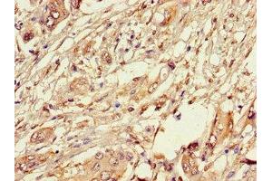 Immunohistochemistry of paraffin-embedded human pancreatic cancer using ABIN7162891 at dilution of 1:100