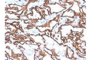 Formalin-fixed, paraffin-embedded human angiosarcoma stained with CD31 Mouse Monoclonal Antibody (PECAM1/3529). (CD31 anticorps  (AA 625-738))