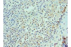 Immunohistochemistry of paraffin-embedded human breast cancer using ABIN7156850 at dilution of 1:100 (IL-21 anticorps  (AA 25-162))