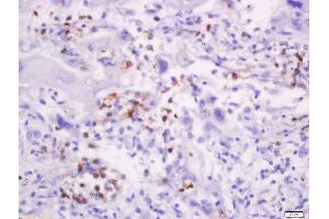 Formalin-fixed and paraffin embedded human lung carcinoma labeled with Anti-CD58/LFA-3 Polyclonal Antibody, Unconjugated  at 1:200 followed by conjugation to the secondary antibody and DAB staining. (CD58 anticorps  (AA 31-130))