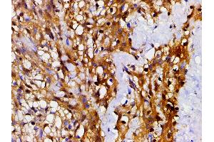 ABIN6267443 at 1/200 staining human meningeal carcinomatosis(MC) tissue sections by IHC-P. (Cofilin anticorps  (pSer3))