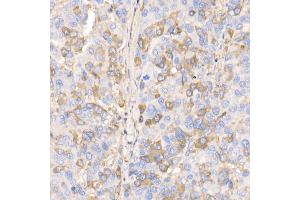 Immunohistochemistry of paraffin-embedded human liver cancer using RA/B Rabbit mAb (ABIN7269790) at dilution of 1:100 (40x lens). (RAB11A anticorps)