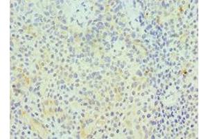 Immunohistochemistry of paraffin-embedded human breast cancer using ABIN7154414 at dilution of 1:100