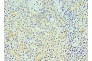 Immunohistochemistry of paraffin-embedded human breast cancer using ABIN7154414 at dilution of 1:100 (GZMA anticorps  (AA 29-262))