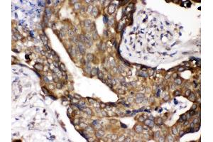 Anti- POR Picoband antibody,IHC(P) IHC(P): Human Mammary Cancer Tissue (POR anticorps  (C-Term))
