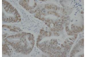 Immunohistochemistry (IHC) image for anti-Tumor Protein P53 (TP53) antibody (ABIN1108553) (p53 anticorps)