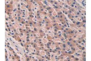 Detection of SEPT5 in Human Liver cancer Tissue using Polyclonal Antibody to Septin 5 (SEPT5)
