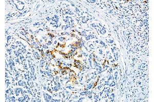 ABIN6263771 and ABIN6277122 at 1/100 staining Human pancreatic cancer and adjacent nomal tissues by IHC-P. (NUMBL anticorps  (C-Term))