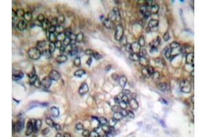 Immunohistochemistry analyzes of Separase antibody in paraffin-embedded human colon carcinoma tissue. (Separase anticorps)