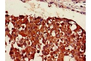 Immunohistochemistry of paraffin-embedded human breast cancer using ABIN7169405 at dilution of 1:100 (SESN1 anticorps  (AA 224-337))