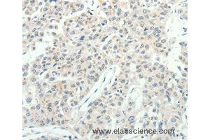 Immunohistochemistry of Human lung cancer using RPAP3 Polyclonal Antibody at dilution of 1:20 (RPAP3 anticorps)