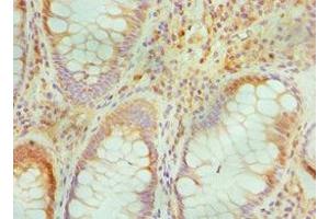 Immunohistochemistry of paraffin-embedded human colon cancer using ABIN7172842 at dilution of 1:100 (TGFBI anticorps  (AA 30-250))