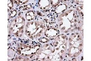 Immunohistochemical staining of paraffin-embedded Carcinoma of prostate tissue using anti-CISD1 mouse monoclonal antibody. (CISD1 anticorps)