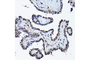 Immunohistochemistry of paraffin-embedded human thyroid cancer using PRMT5 Rabbit pAb (ABIN3022065, ABIN3022066, ABIN3022067 and ABIN6218592) at dilution of 1:200 (40x lens). (PRMT5 anticorps  (AA 40-140))