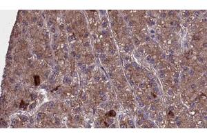 ABIN6273977 at 1/100 staining Human liver cancer tissue by IHC-P.