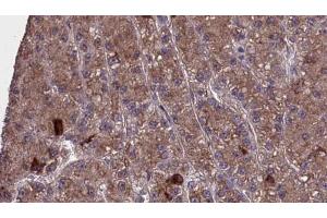 ABIN6273977 at 1/100 staining Human liver cancer tissue by IHC-P. (OR2H1 anticorps  (C-Term))